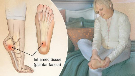 Plantar Fasciitis: Your Comprehensive Guide to Understanding and Managing Heel Pain